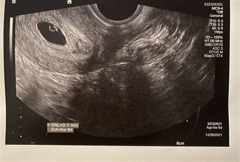 ultrasound dating 1 week behind